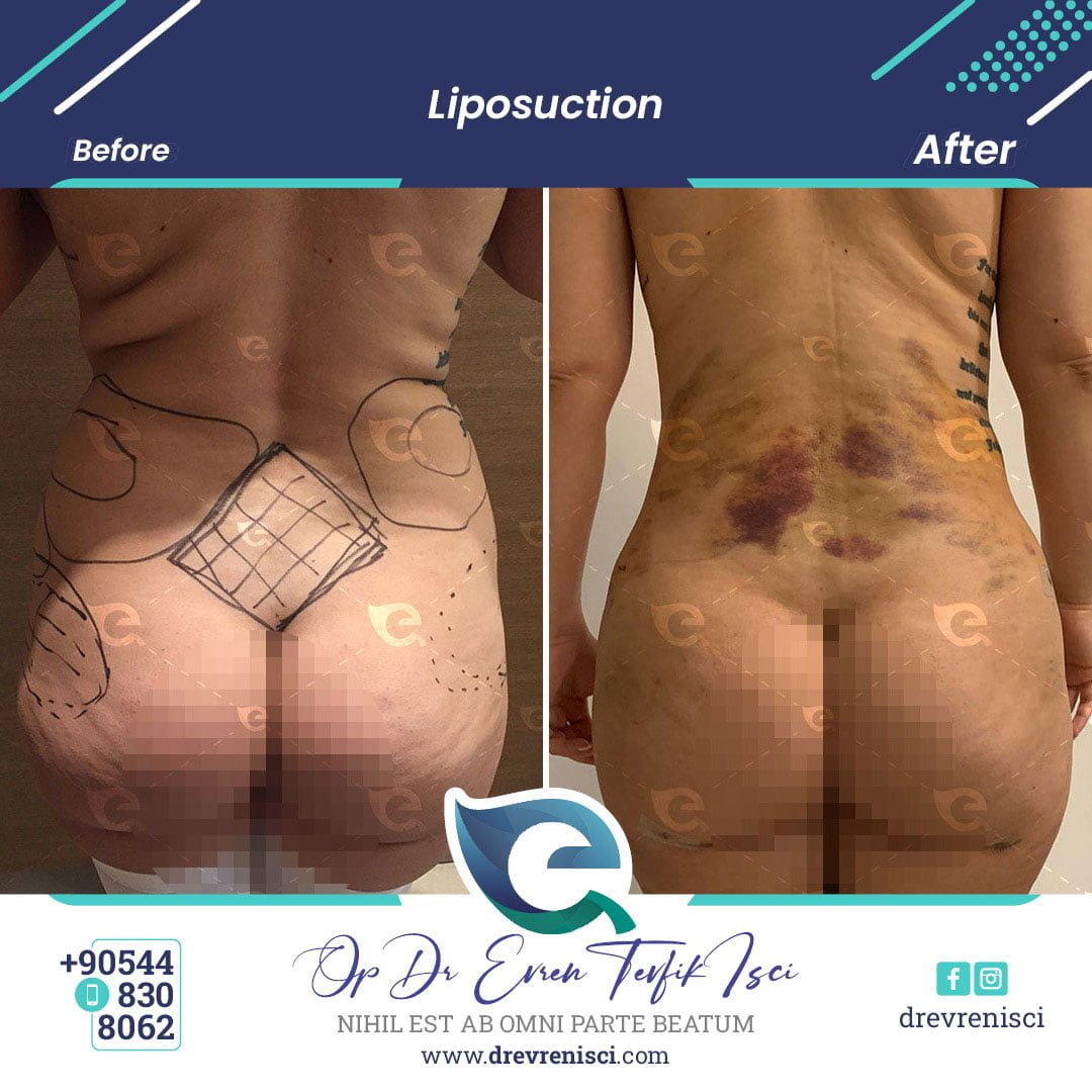 Liposuction Sonrası Hastanede Kalma Süresi ve Uzman Tavsiyeleri [2026] - Kapak Görseli